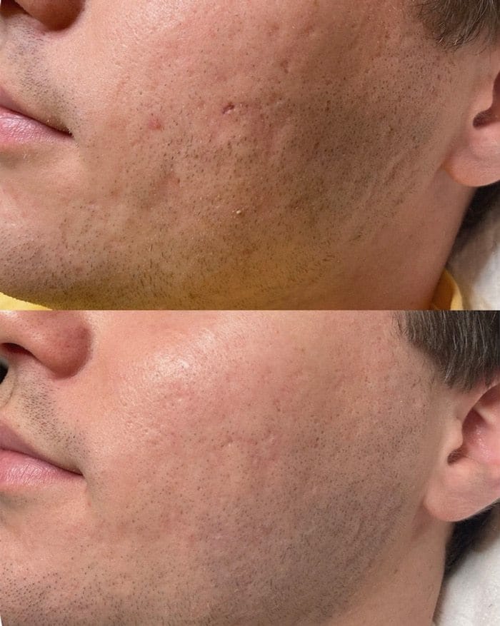 Microneedling-for-Acne-Scars-–-Before-and-After-3-treatments