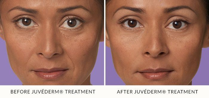 juvederm-before-after-3-ed33a564