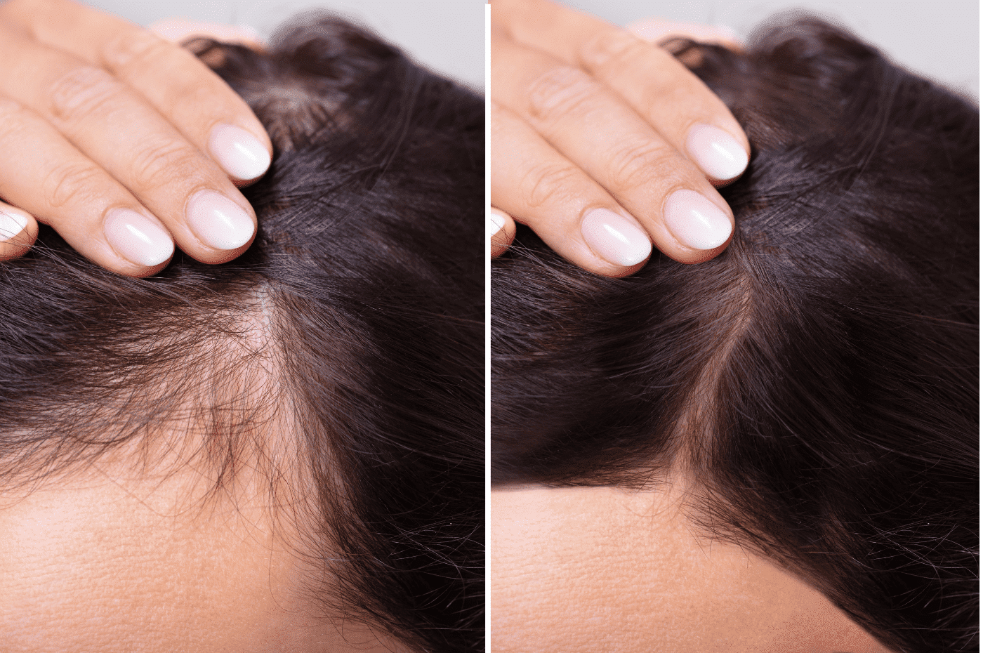 hair loss treatment with prp